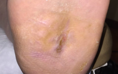 Delays in Diabetic Shoe Authorization Give Us All a Black Eye