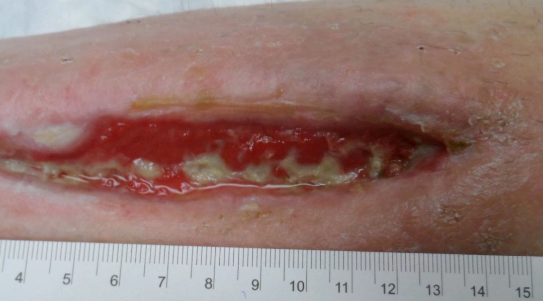 The Hidden Costs of Wound Care