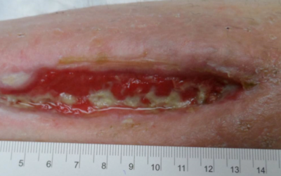 The Hidden Costs of Wound Care