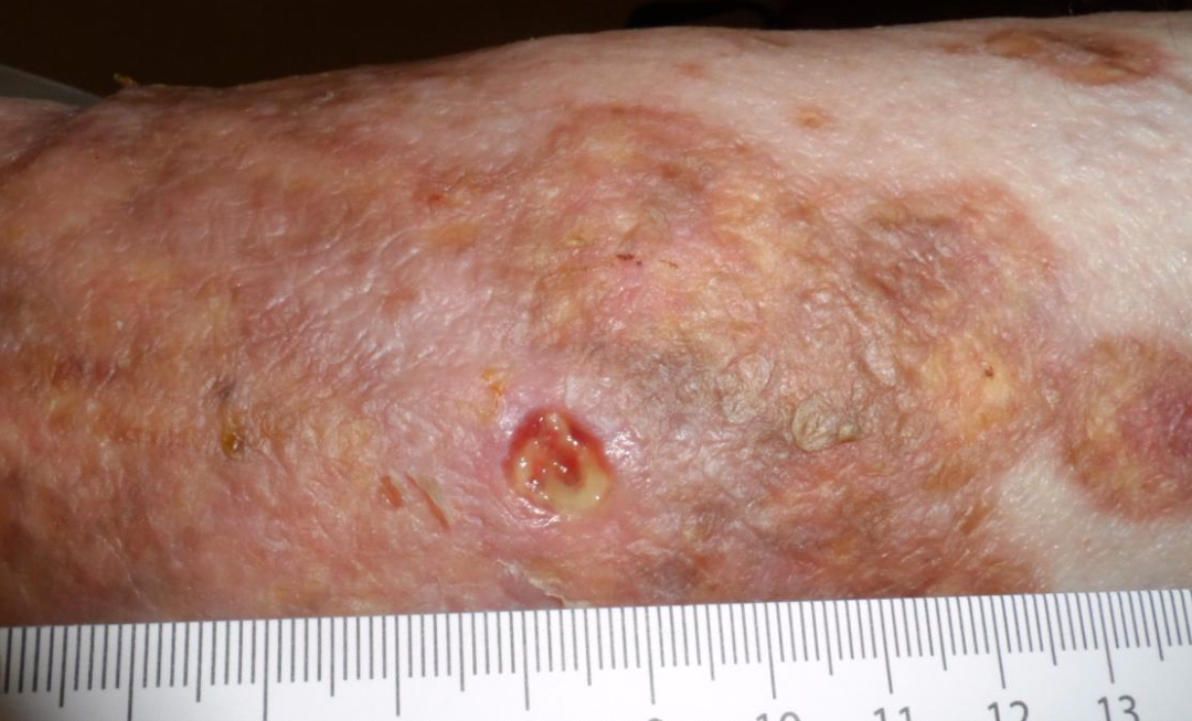 Granuloma annulare, necrobiosis lipoidica diabeticorum és gyermekkori cukorbetegség