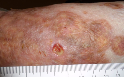 Don't Miss This – Necrobiosis Lipoidica Diabeticorum