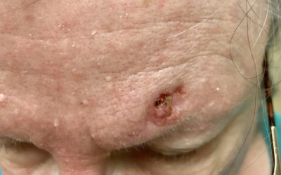 Skin Cancer Meets the Medicare "DIS-Advantage" Plan