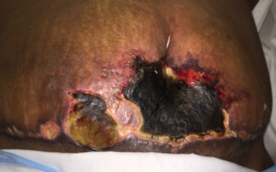 Buyer Beware: Low-Budget Tummy Tucks in the Caribbean