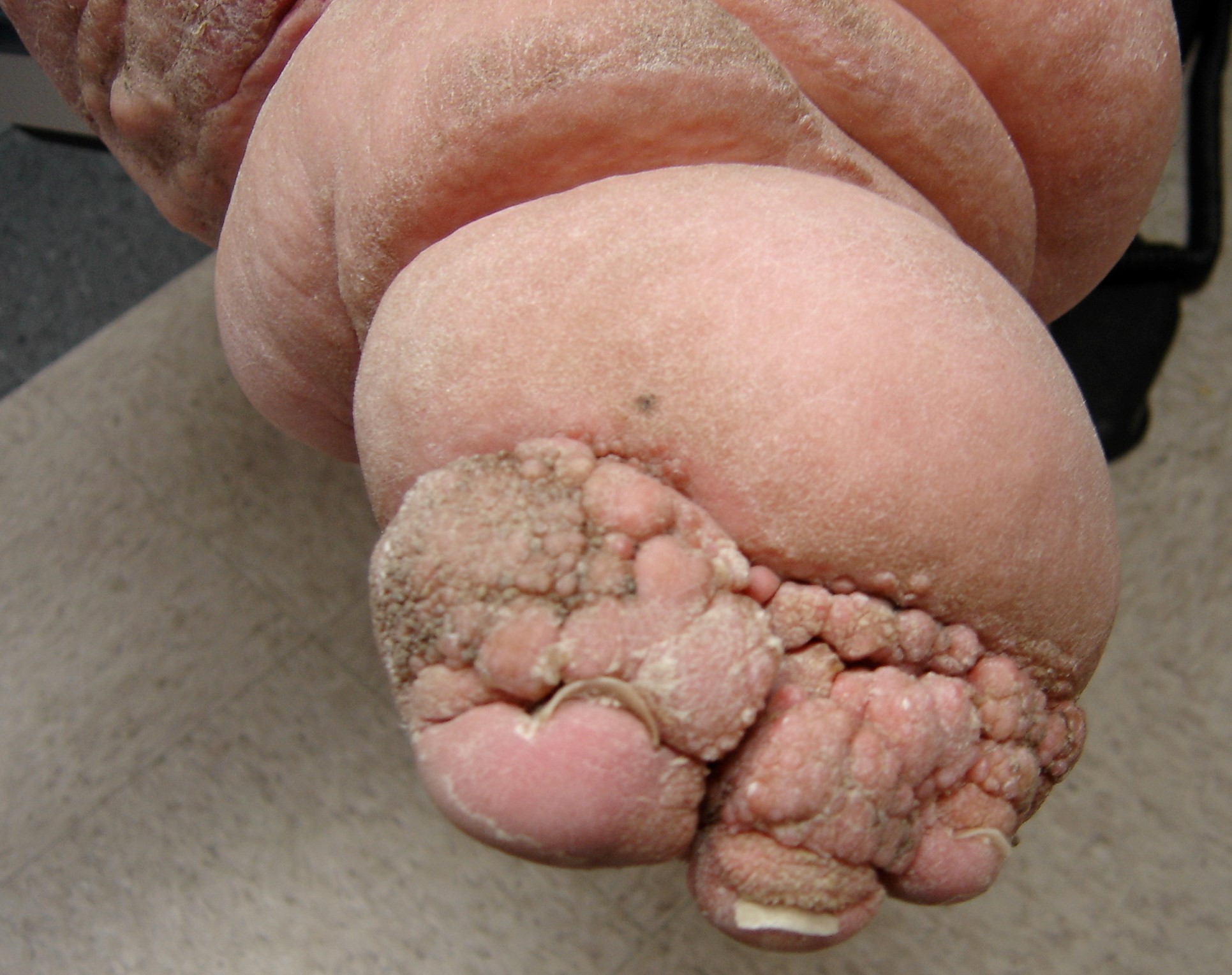 Papillomas in lymphedema - Lymphedema People ™ • View topic - Limfedemul