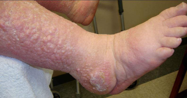 papillomatosis in lymphedema)