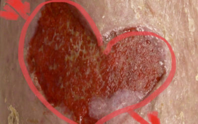 Valentine's Day Meets Venous Disease