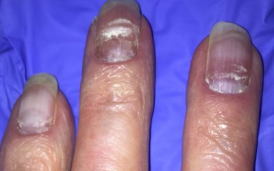 Don't Miss This – Fingernail Findings