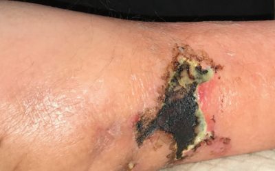 Don't Miss This: Calciphylaxis (Calcific Uremic Arteriopathy)