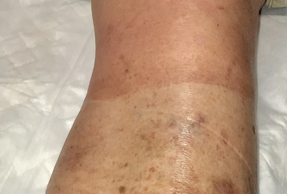Photo Quiz: How Can You Tell a Patient Has Worn Their Compression?