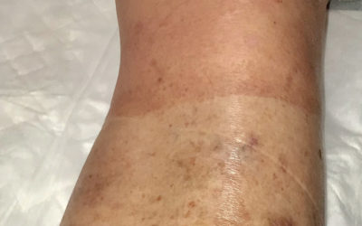 Photo Quiz: How Can You Tell a Patient Has Worn Their Compression?