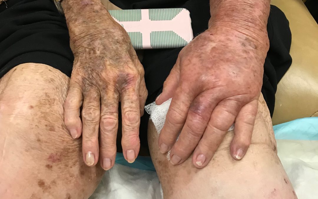The Inconvenient Truth in a Convenience Sample – the Prevalence of Lymphedema in a Wound Clinic