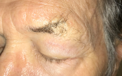 Don't Miss This – Madarosis