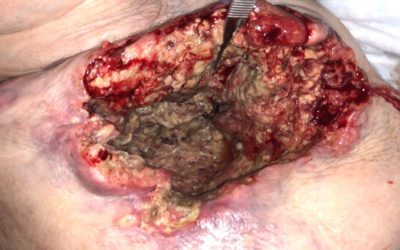 Don’t Miss This: The Importance of Biopsy (Guest Post by Dr. Rafael Rafols, MD)