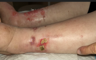 Don't Miss This: Chronic Ulcers Due to Influenza? Sort of…