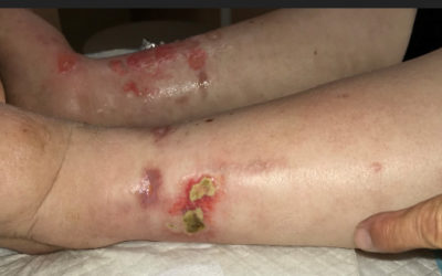 Don't Miss This: Chronic Ulcers Due to Influenza? Sort of…