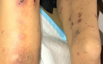 Don't Miss This – Kyrle's Disease