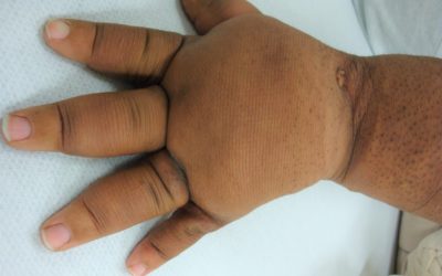 3 Patients with Lymphedema of the Hand – One of Them Has Open Wounds – Why?