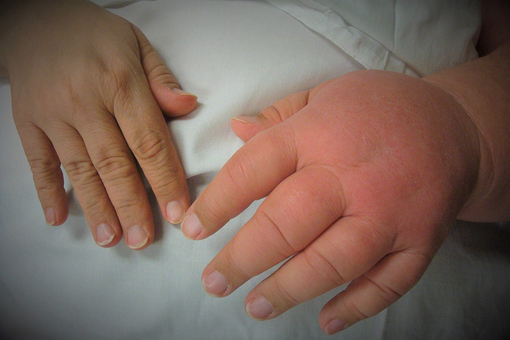 3 Patients with Lymphedema of the Hand – One of Them Has Open Wounds