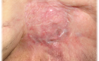 Transdermal Oxygen for the Irradiated Field – I’ll Be Darned if it Didn’t Work!