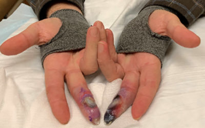 OxyBand and Digital Ischemia