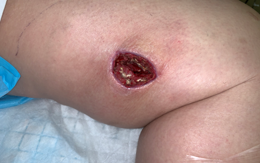 Don’t Miss This: Mucormycosis
