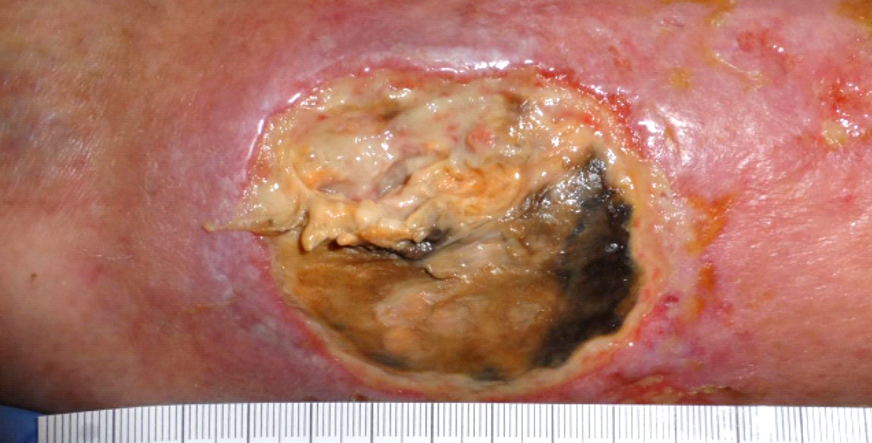 Malnutrition Presenting as a Necrotic Ulcer