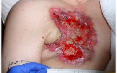 The Saga of an Autoamputated Breast, Local Radiation and Transdermal Oxygen with OxyBand