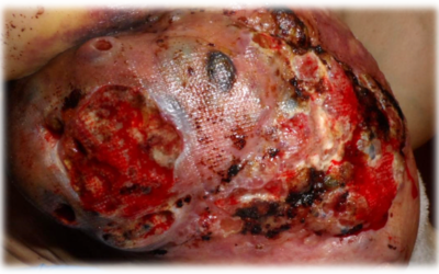 Cancer, Biofilm and the Keto Diet