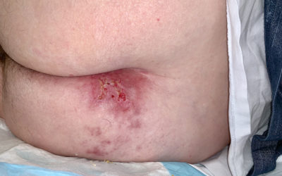 Don't Miss This: This One is Neither a Pressure Ulcer Nor a Pressure Injury