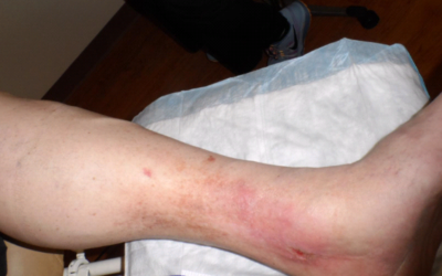 Does Venous Reflux a Venous Ulcer Make?
