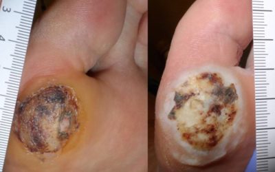 Chance Favors the Prepared Mind… and Why Wound Care is a Game of Duck, Duck, Goose