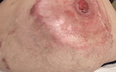 I Missed It! Ehlers-Danlos Syndrome as the Cause of Wound Healing Problems