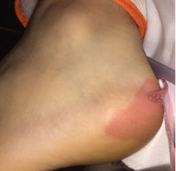 Yes! It IS a Pressure Injury! An Ischemia Reperfusion Injury…