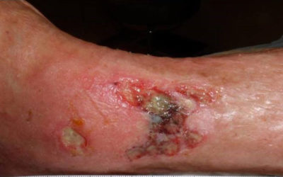 Pondering DNA Assay of Wounds: It only Matters When it Matters