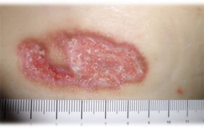 Pyoderma Gangrenosum (PG): Not So Rare, and When in Doubt, Take a History.