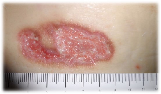 Pyoderma Gangrenosum (PG): Not So Rare, and When in Doubt, Take a History.
