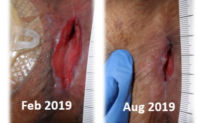 EDS-Related Wound Dehiscence, a Not-So-Rare Condition in Wound Care