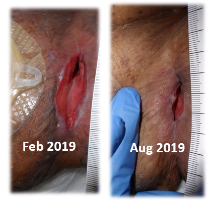 EDS-Related Wound Dehiscence, a Not-So-Rare Condition in Wound Care