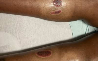 UPDATE: Wounds are a SYMPTOM – What’s the Diagnosis? Crowdsourcing Tough Wound Diagnoses