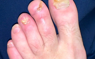 Use of Transdermal Oxygen (OxyBand) for Distal Toe Re-attachment