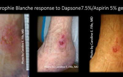 Hope for Atrophie Blanche with Compounded Topical Dapsone and Aspirin