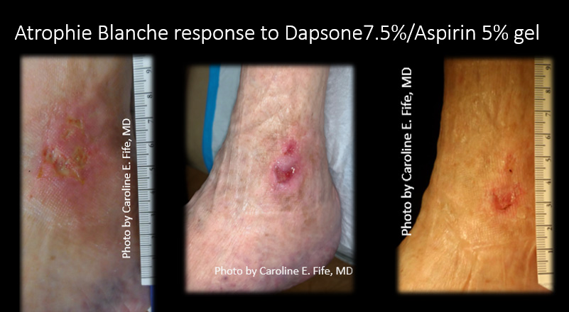 Hope for Atrophie Blanche with Compounded Topical Dapsone and Aspirin