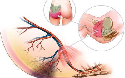 Severe Pressure Injuries Form From the Inside Out!