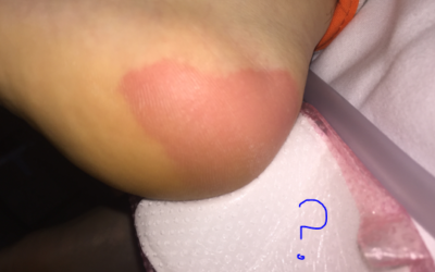 What’s Wrong With This Picture? Why Foam Pads Can’t Prevent Ischemic Injuries