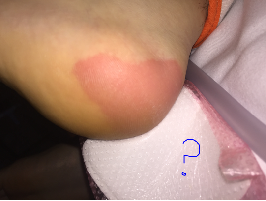 What’s Wrong With This Picture? Why Foam Pads Can’t Prevent Ischemic Injuries
