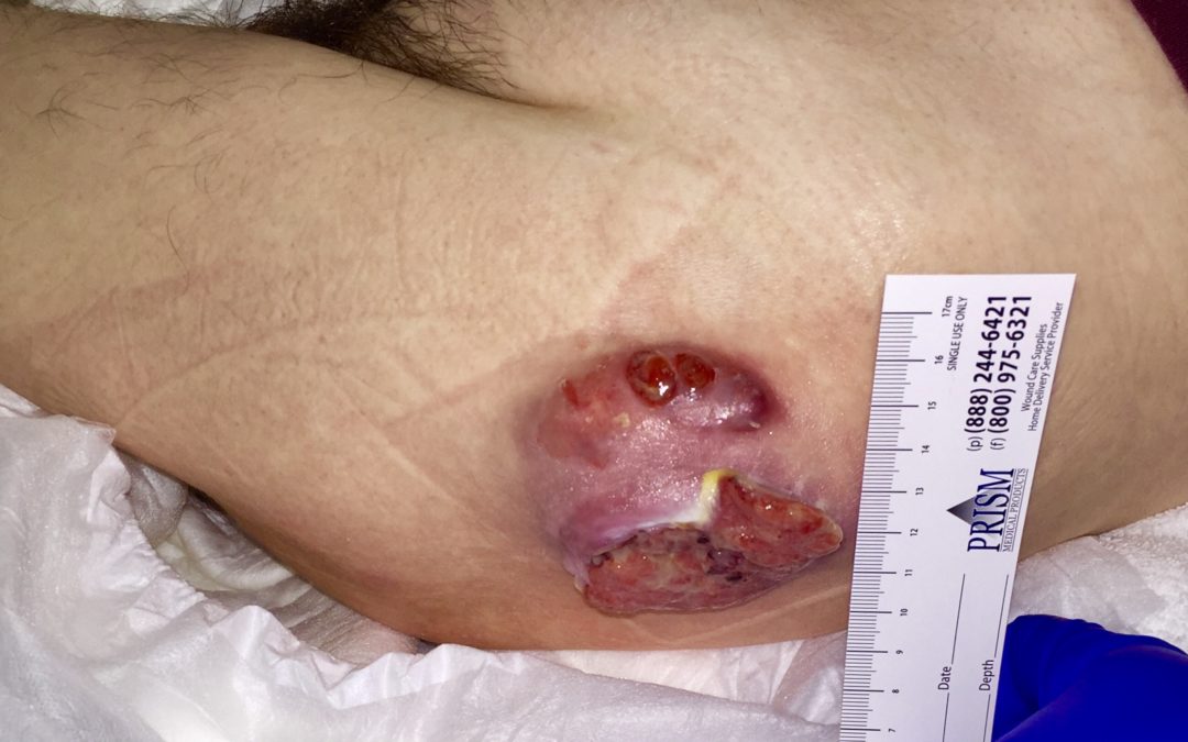 Don’t Miss This – It’s Not A Pressure Injury, It’s Pyoderma Gangrenosum