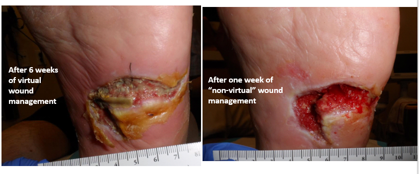 Virtually Disappointing Wound Management