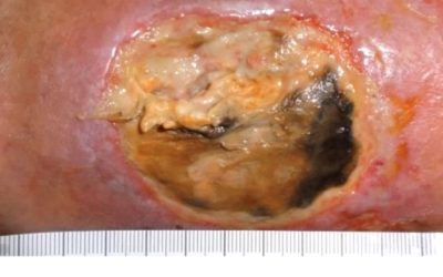 Malnutrition Presenting as a Chronic Ulcer