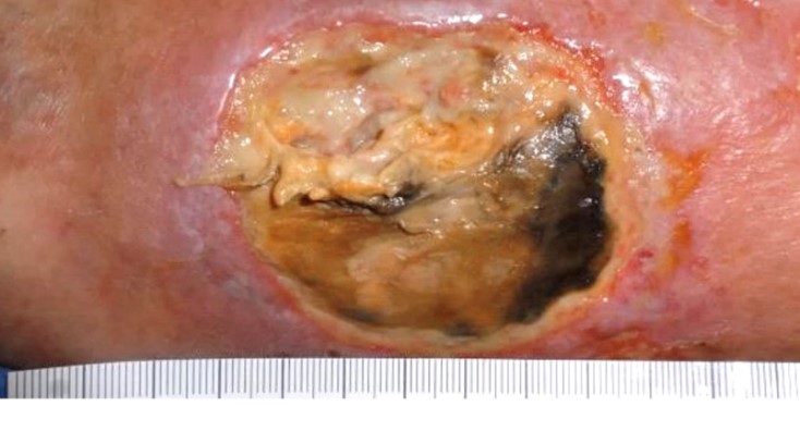 Malnutrition Presenting as a Chronic Ulcer