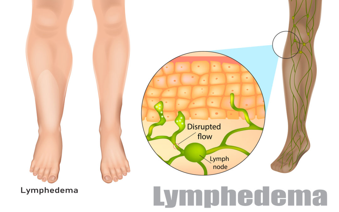 Lipedema & Lymphedema Patient Round Table Discussions Available on YouTube